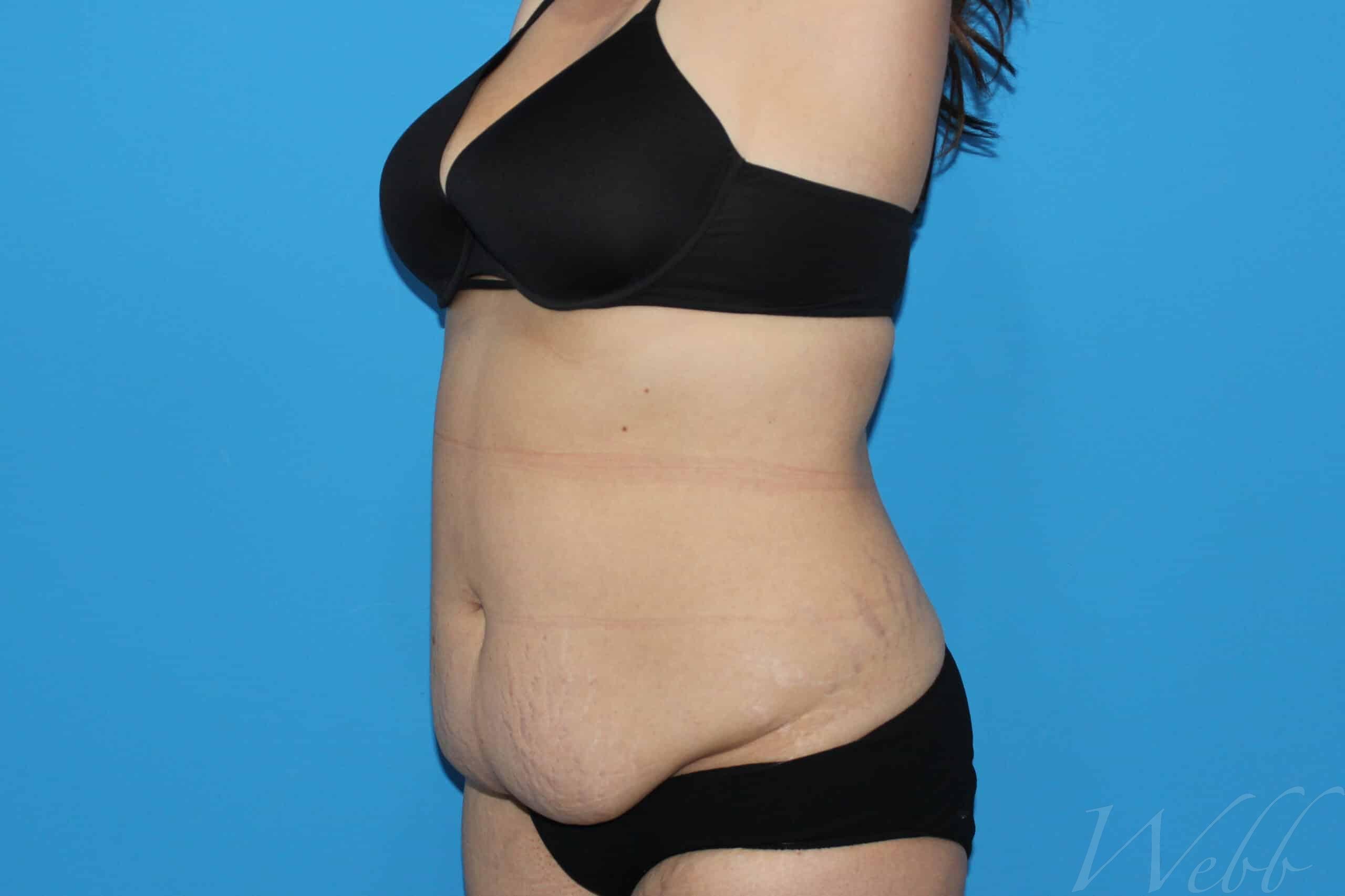 tummy tuck patient