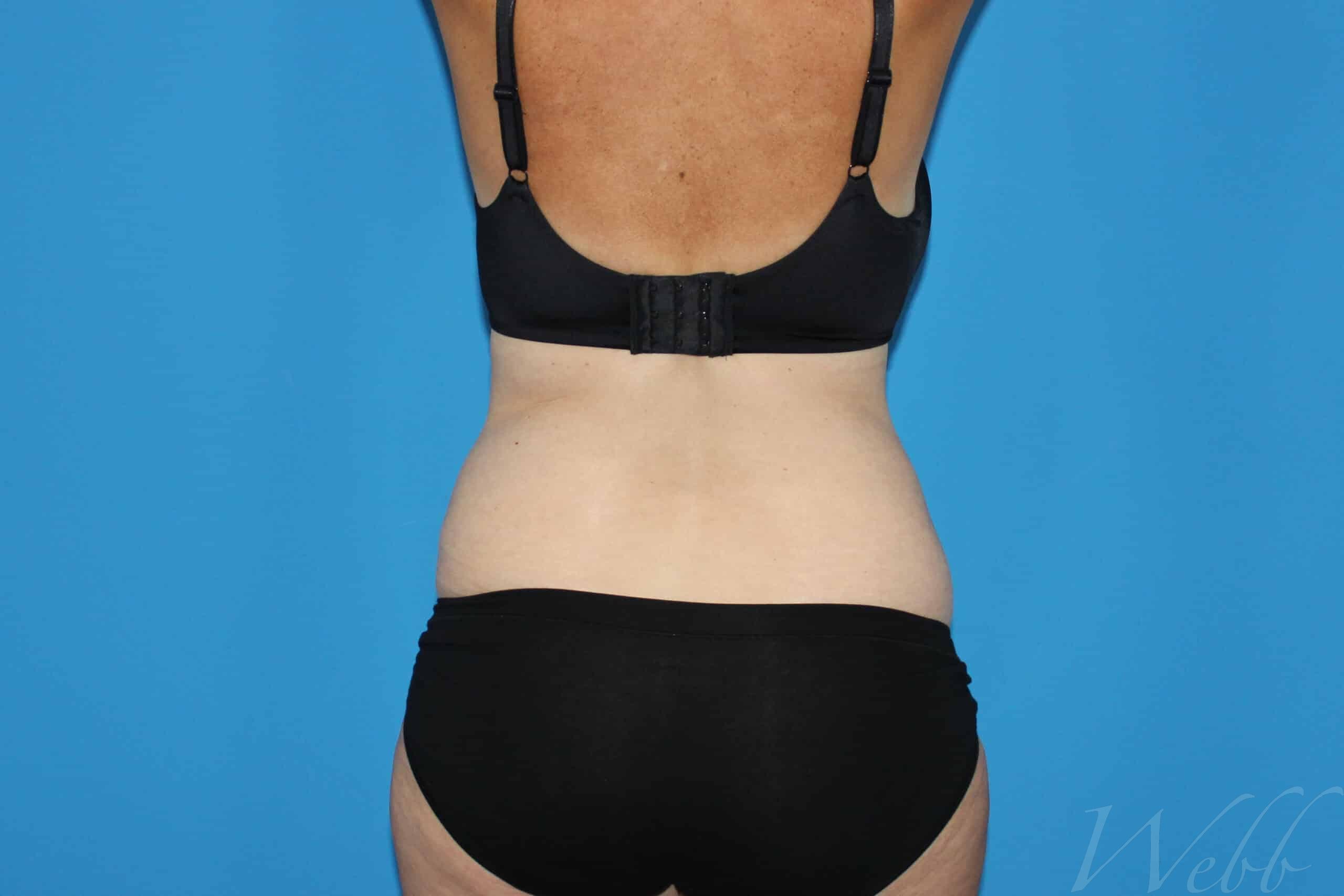 tummy tuck patient