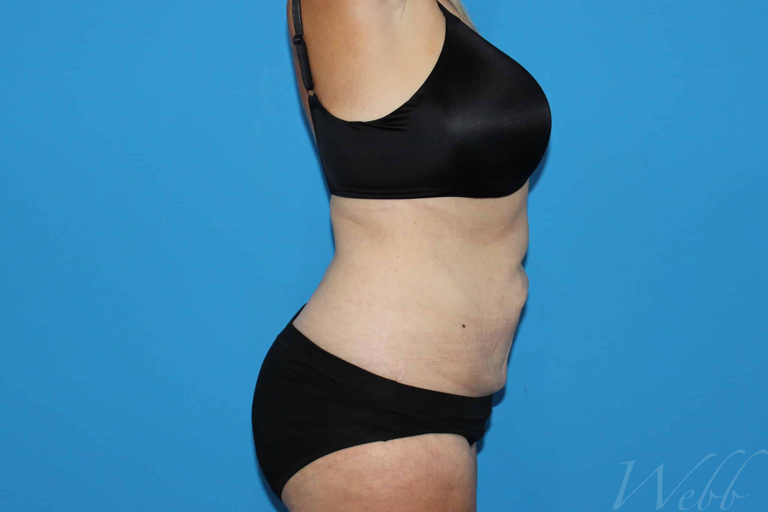 tummy tuck patient