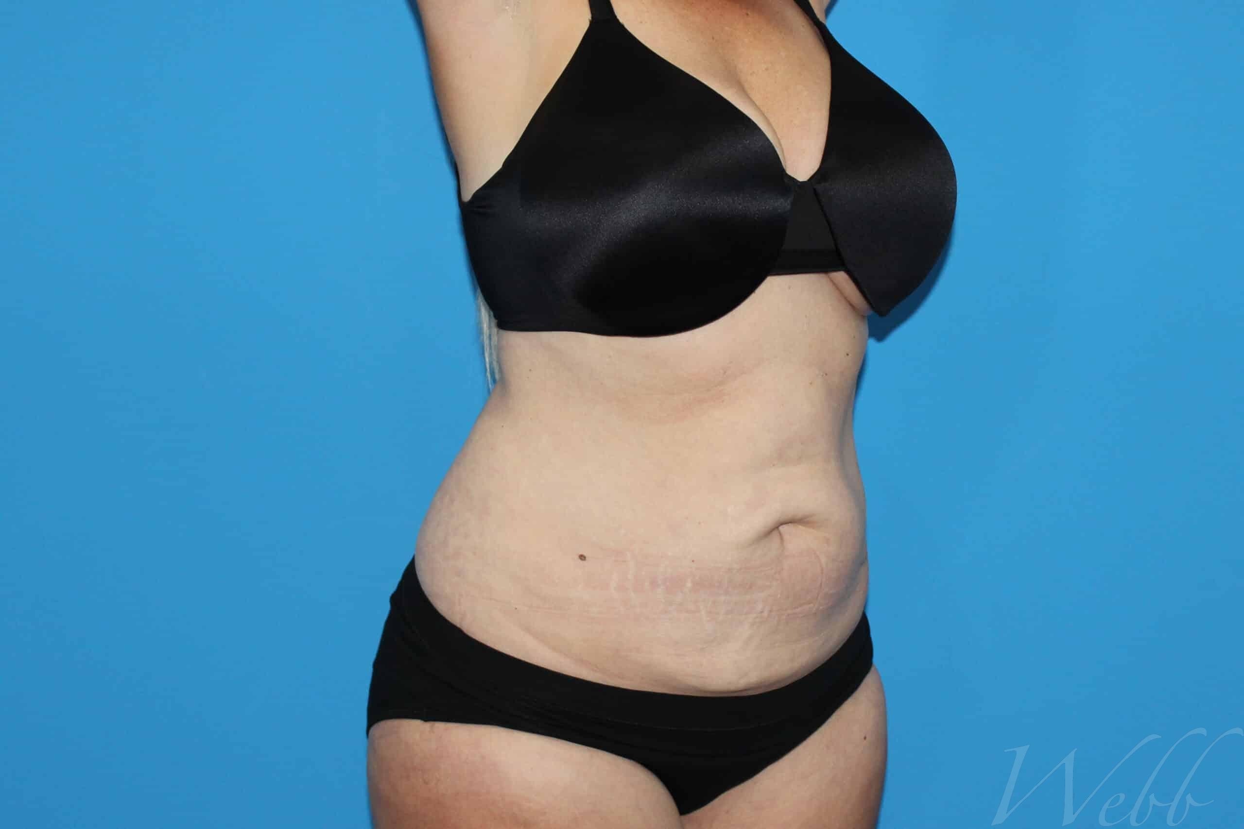 tummy tuck patient