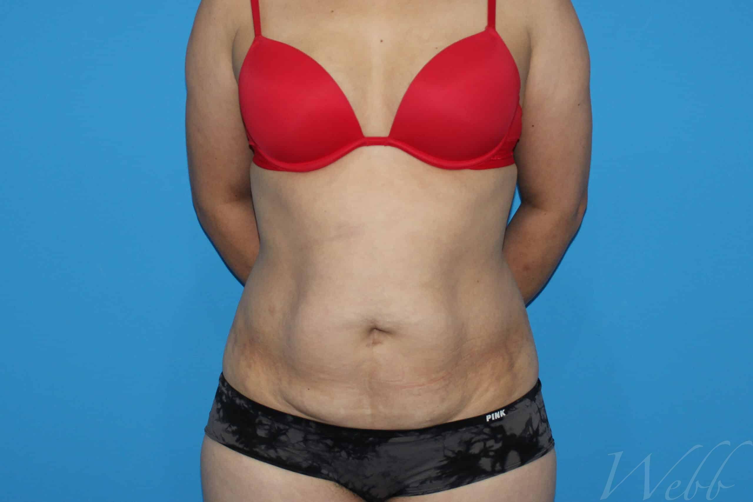 tummy tuck patient