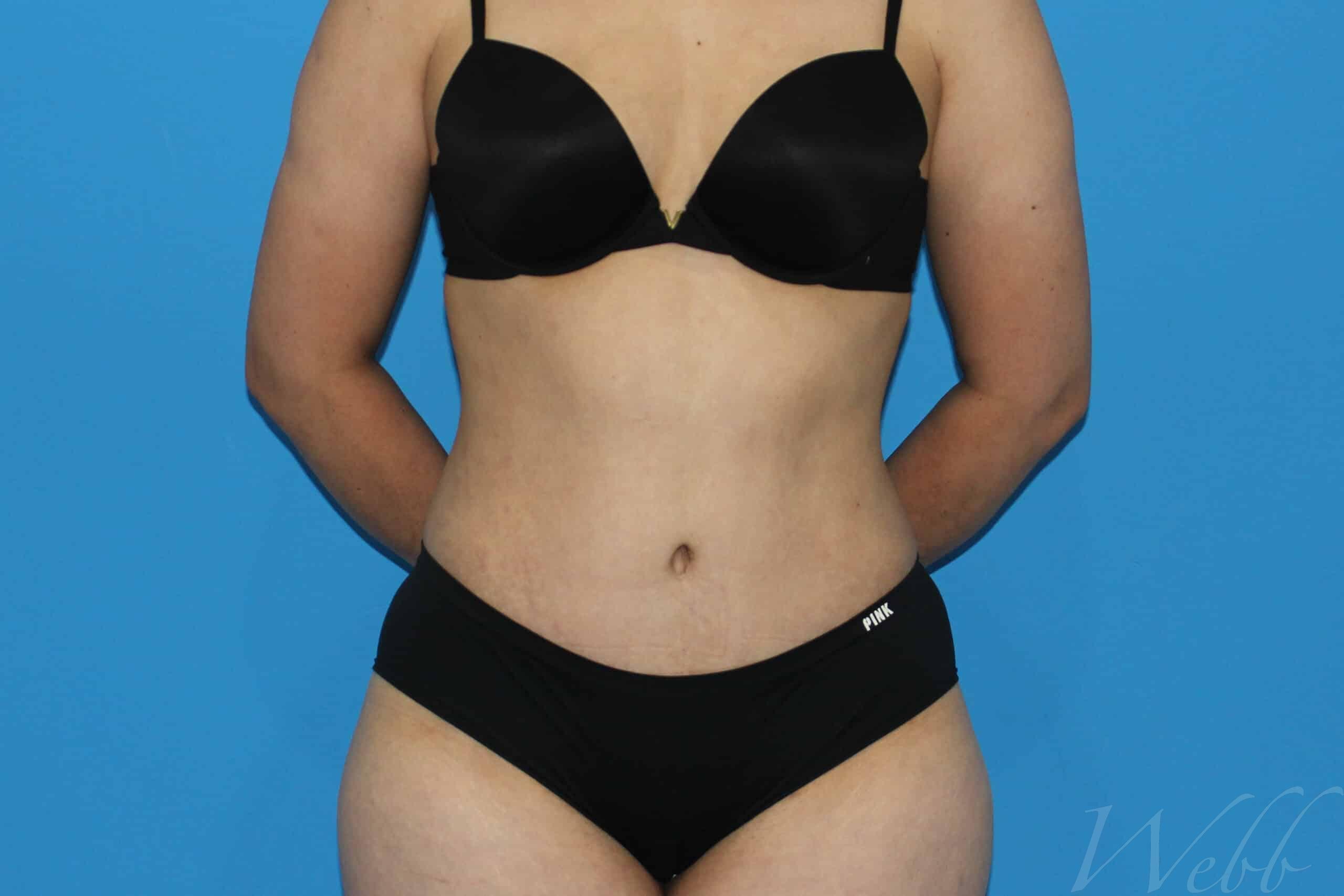 tummy tuck patient