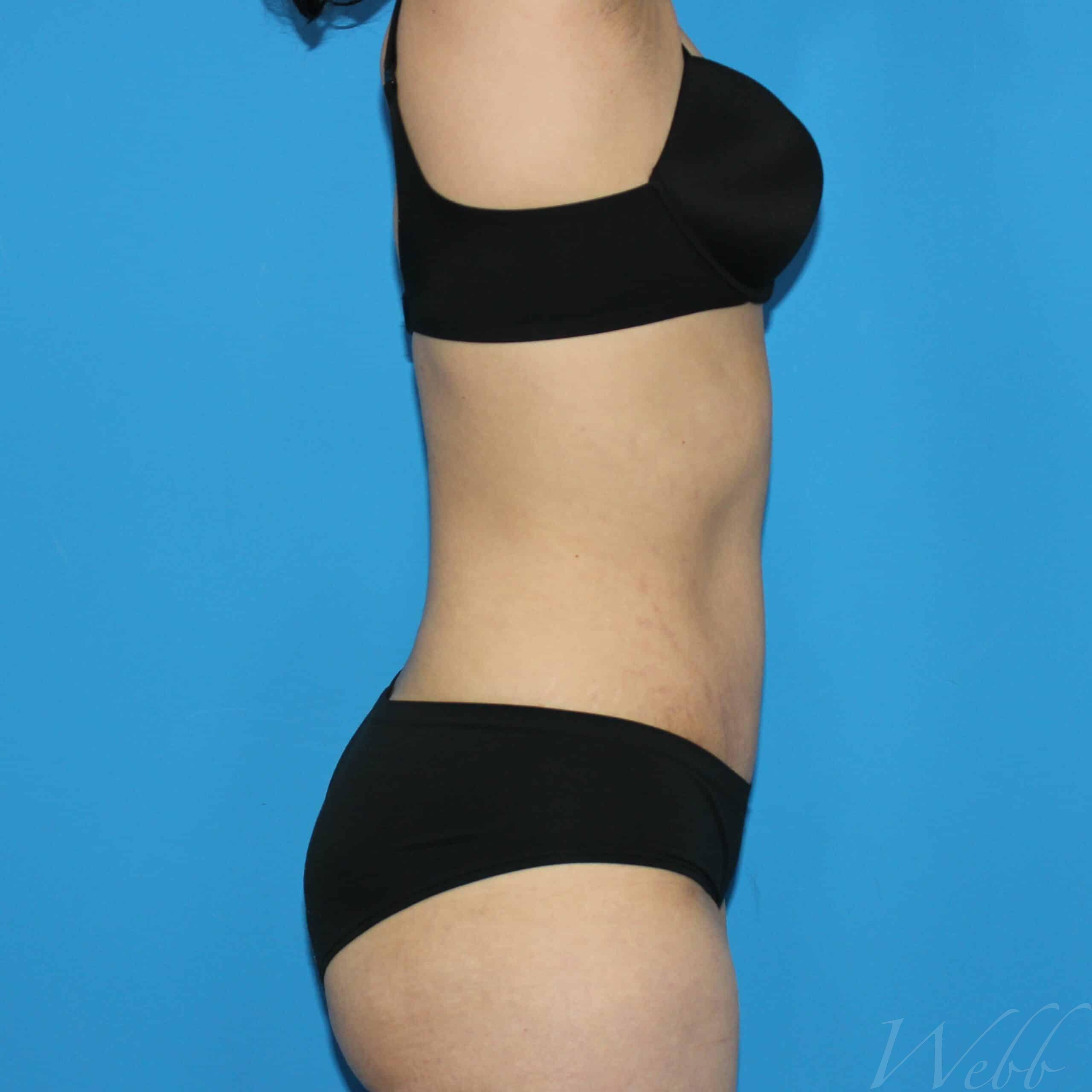 tummy tuck patient