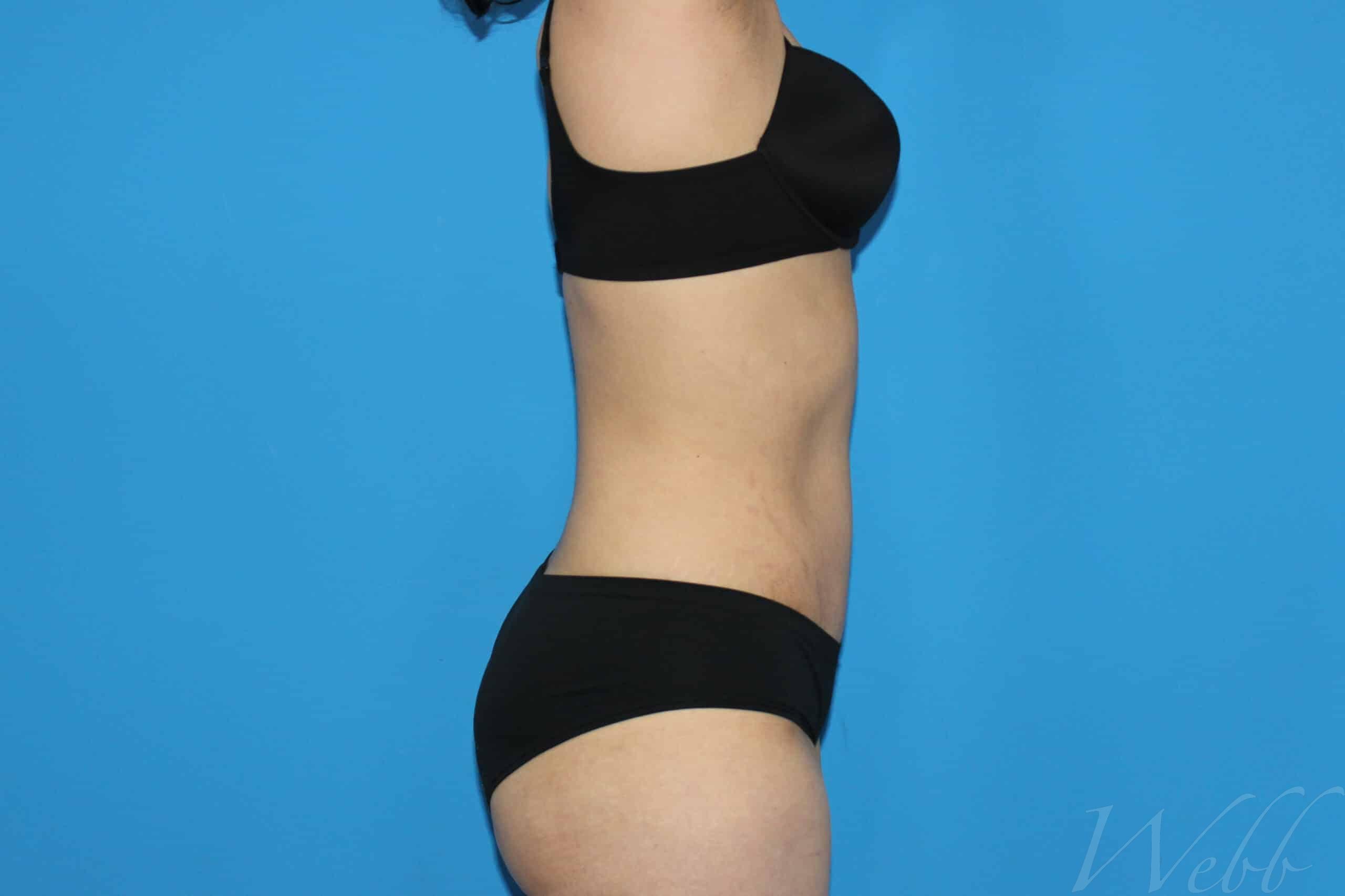 tummy tuck patient