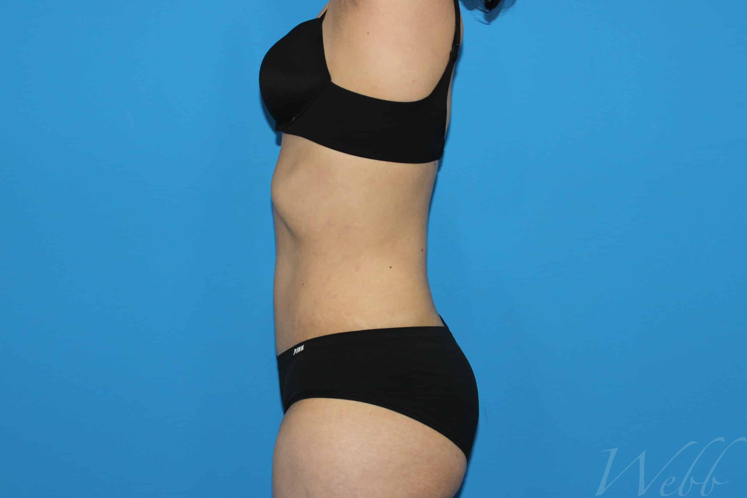 tummy tuck patient