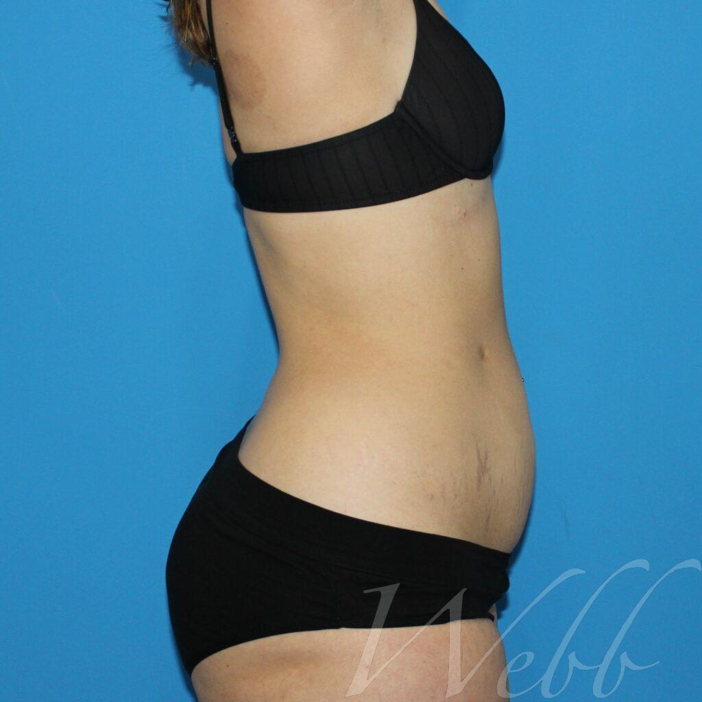 tummy tuck patient