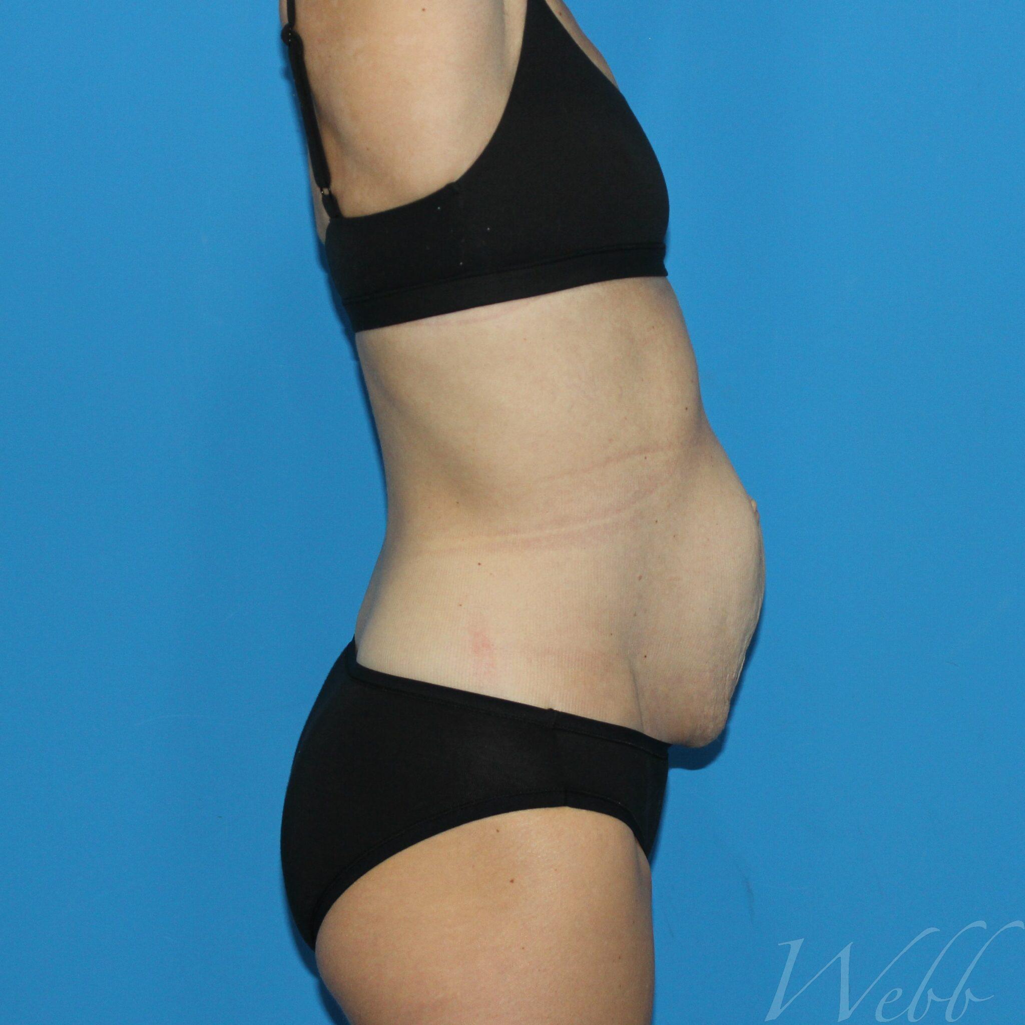 A 40-year-old Woman In Underwear With Sagging Breasts, Overweight